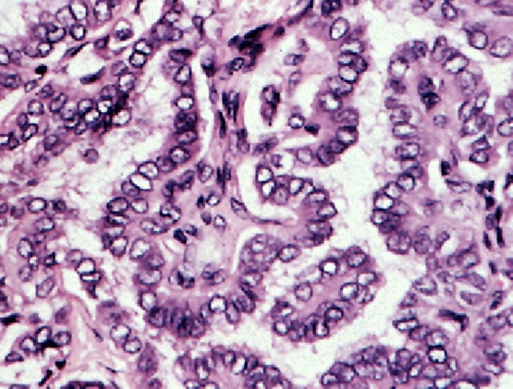 Pathology Outlines Papillary Carcinoma General